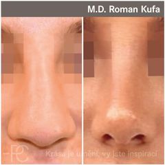 Rhinoplastika - Perfect Clinic - centrum estetické medicíny