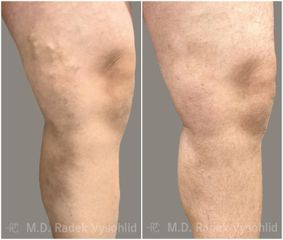 Odstranění křečových žil - Perfect Clinic - centrum estetické medicíny