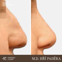 Rhinoplastika - Perfect Clinic - centrum estetické medicíny
