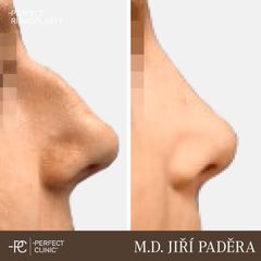 Rhinoplastika - Perfect Clinic - centrum estetické medicíny