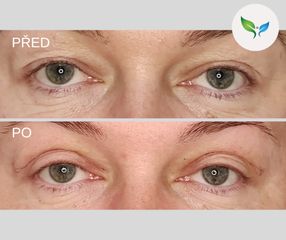 Operace horních víček - My Best Care s. r. o. - klinika estetické dermatologie a plastické chirurgie