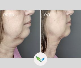 Liposukce podbradek - My Best Care s. r. o. - klinika estetické dermatologie a plastické chirurgie