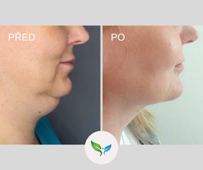 Liposukce - My Best Care s. r. o. - klinika estetické dermatologie a plastické chirurgie