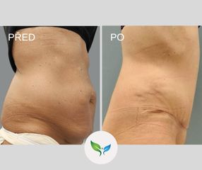 Liposukce a abdominoplastika - My Best Care s. r. o. - klinika estetické dermatologie a plastické ch