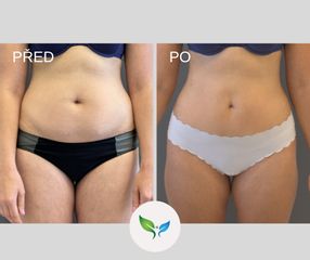 Miniabdominoplastika a liposukce zepredu