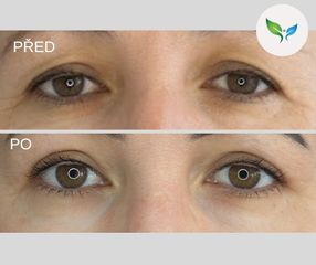 Blepharoplastika před a po