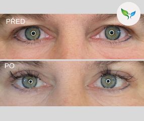 Blepharoplastika před a po