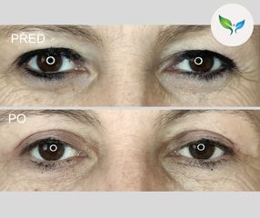 Blepharoplastika před a po