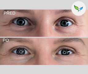 Blepharoplastika před a po