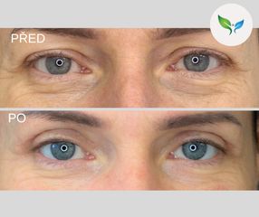 Blepharoplastika před a po