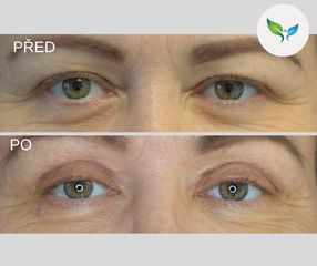 Blepharoplastika před a po