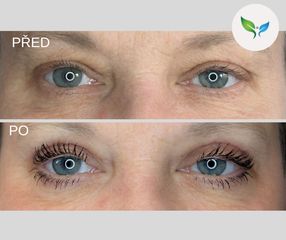 Blepharoplastika před a po