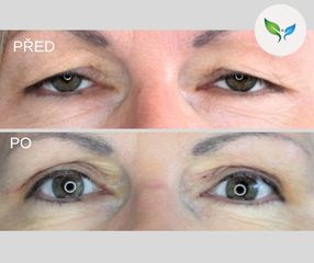 Blepharoplastika před a po