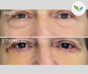 Dolní víčka před a 2 týdny po