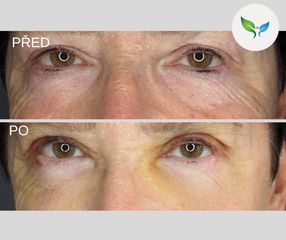 Dolní víčka před a po