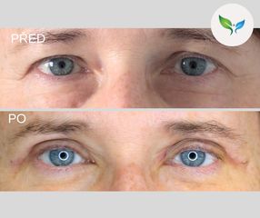 Horní víčka před a po