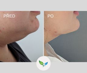Liposukce podbradku před a po