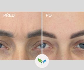 Odstraneni vrasek před a po