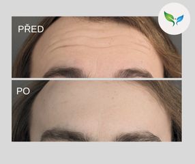 Odstranění vrásek před a po