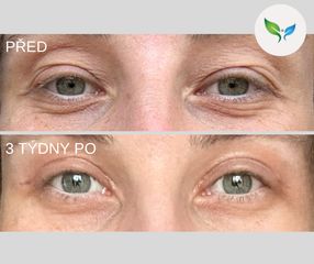 Operace víček před a po