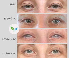 Plastika víček před a po