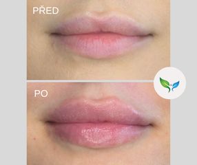 zvětšení rtů před a po