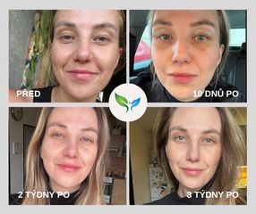 Víčka - timeline