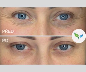 Hybridní výplň pod oči