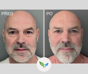 Dolní víčka před a po