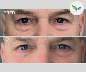 Operace dolních víček před a po