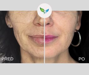 Tekutý lifting před a po