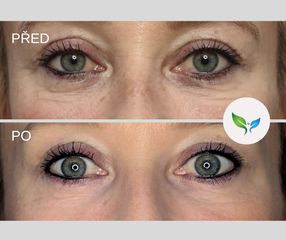 Hybridní výplň pod oči před a po