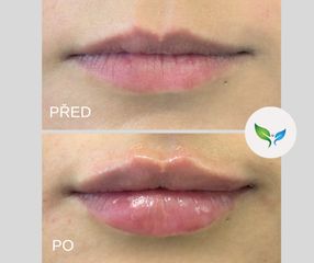 zvětšení rtů před a po