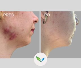 laser - akné - odstranění jizev