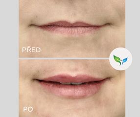 zvětšení rtů kyselinou hyaluronovou