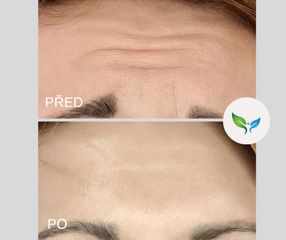 odstranění vrásek čelo