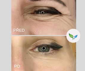 odstranění vrásek kolem očí