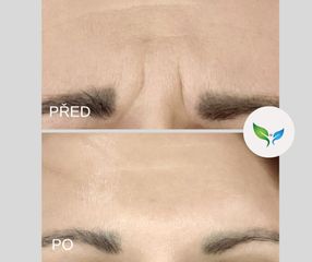 odstranění vrásek glabela - mračivka