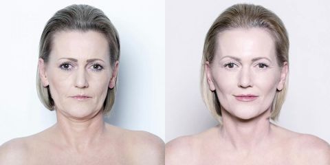 MyFaceLift