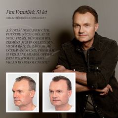 Facelift - MEDICOM Clinic
