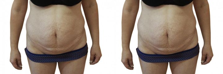 Abdominoplastika s liposukcí břicha a boků