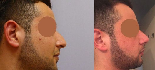 Plastická operace nosu (Rhinoplastika)
