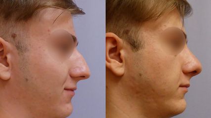 Plastika nosu (Rhinoplastika) - MUDr. Kamila Šormová