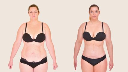 Abdominoplastika - Klinika YES VISAGE