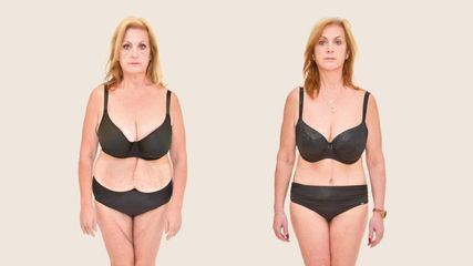 Abdominoplastika - Klinika YES VISAGE