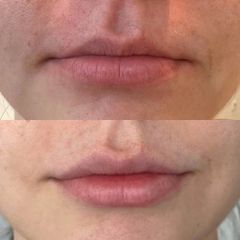 Zvětšení rtů - kyselina hyaluronová - Klinika YES VISAGE