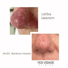 Laserová dermatologie - Klinika YES VISAGE