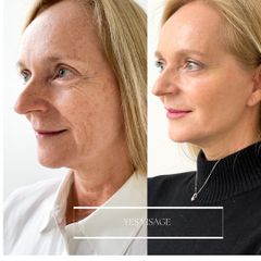 Facelift - Klinika YES VISAGE