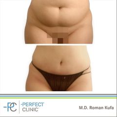 Abdominoplastika (Operace břicha) - MUDr. Roman Kufa - Perfect Clinic