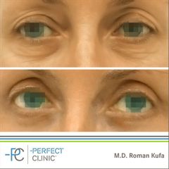 Operace očních víček (Blefaroplastika) - MUDr. Roman Kufa - Perfect Clinic